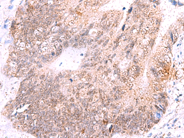 Immunohistochemistry of paraffin-embedded Human colorectal cancer tissue using ASTN2 Polyclonal Antibody at dilution of 1:55(×200)
