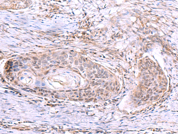 Immunohistochemistry of paraffin-embedded Human esophagus cancer tissue using AKAP17A Polyclonal Antibody at dilution of 1:80(×200)