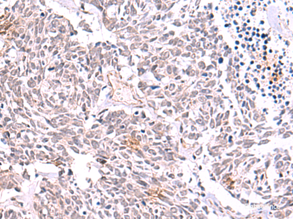 Immunohistochemistry of paraffin-embedded Human lung cancer tissue using TRMT12 Polyclonal Antibody at dilution of 1:85(×200)