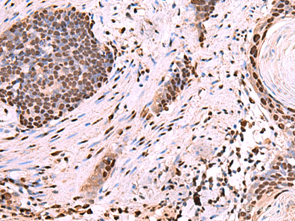 Immunohistochemistry of paraffin-embedded Human esophagus cancer tissue using NASP Polyclonal Antibody at dilution of 1:60(×200)