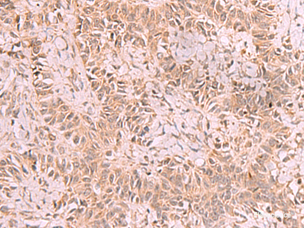 Immunohistochemistry of paraffin-embedded Human ovarian cancer tissue using RRP8 Polyclonal Antibody at dilution of 1:70(×200)