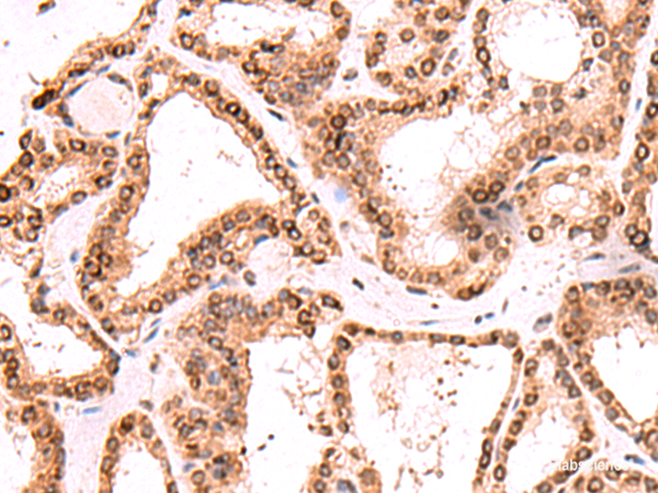 Immunohistochemistry of paraffin-embedded Human thyroid cancer tissue using TOR1AIP1 Polyclonal Antibody at dilution of 1:60(×200)