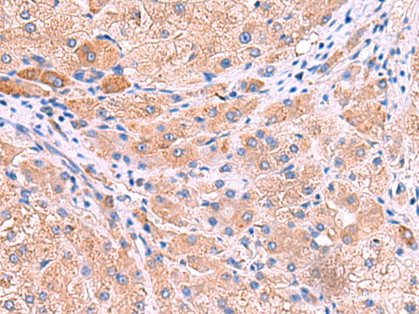 Immunohistochemistry of paraffin-embedded Human liver cancer tissue using MPP1 Polyclonal Antibody at dilution of 1:50(×200)