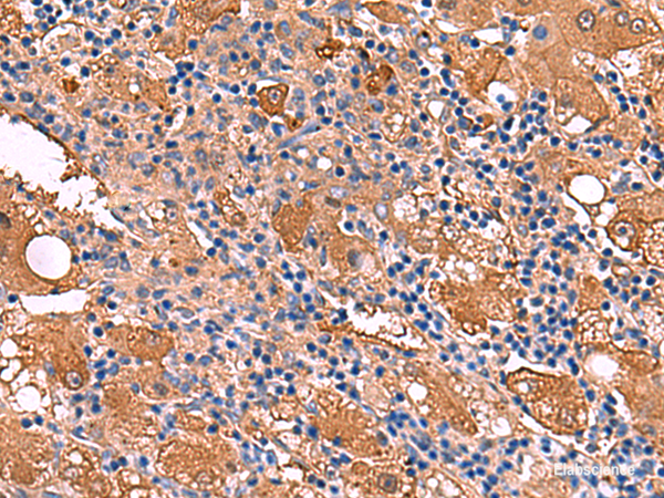 Immunohistochemistry of paraffin-embedded Human liver cancer tissue using FUCA2 Polyclonal Antibody at dilution of 1:80(×200)