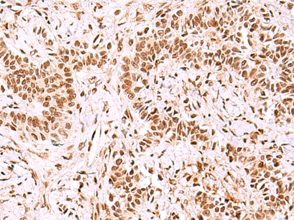 Immunohistochemistry of paraffin-embedded Human ovarian cancer tissue using GPKOW Polyclonal Antibody at dilution of 1:100(×200)
