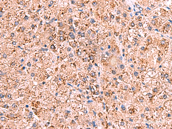 Immunohistochemistry of paraffin-embedded Human liver cancer tissue using OSBPL2 Polyclonal Antibody at dilution of 1:65(×200)