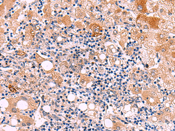 Immunohistochemistry of paraffin-embedded Human liver cancer tissue using KATNAL1 Polyclonal Antibody at dilution of 1:80(×200)