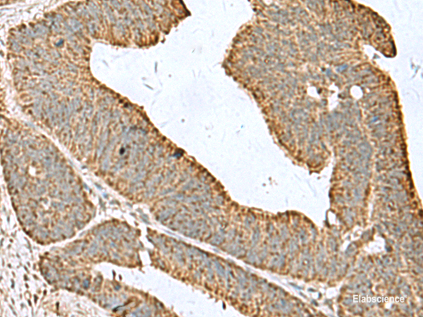 Immunohistochemistry of paraffin-embedded Human colorectal cancer tissue using CDC20 Polyclonal Antibody at dilution of 1:50(×200)