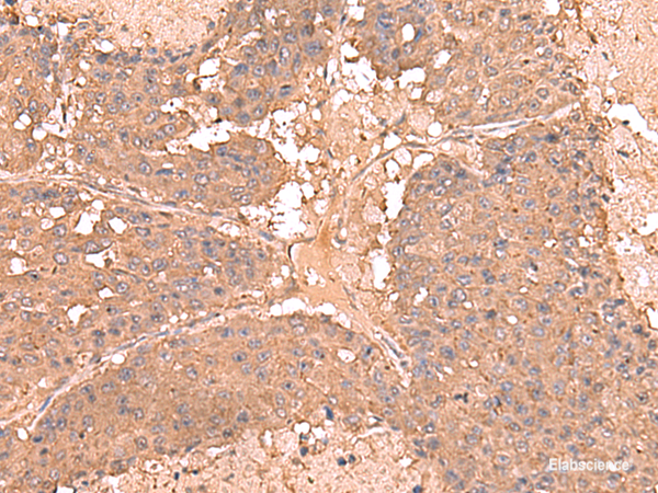 Immunohistochemistry of paraffin-embedded Human liver cancer tissue using AHCYL1 Polyclonal Antibody at dilution of 1:65(×200)