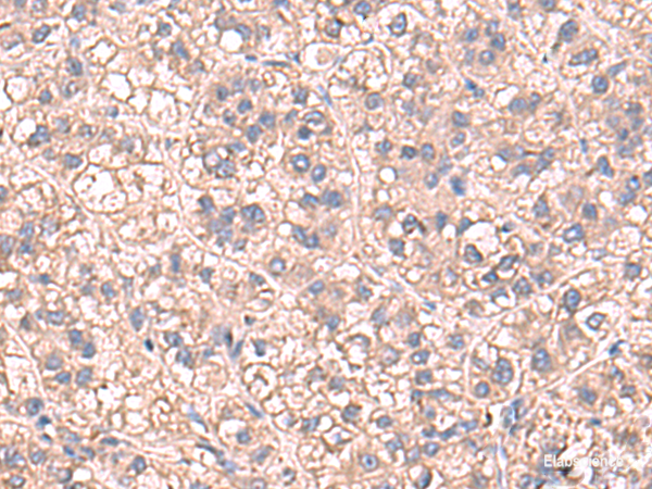 Immunohistochemistry of paraffin-embedded Human liver cancer tissue using SARS Polyclonal Antibody at dilution of 1:60(×200)