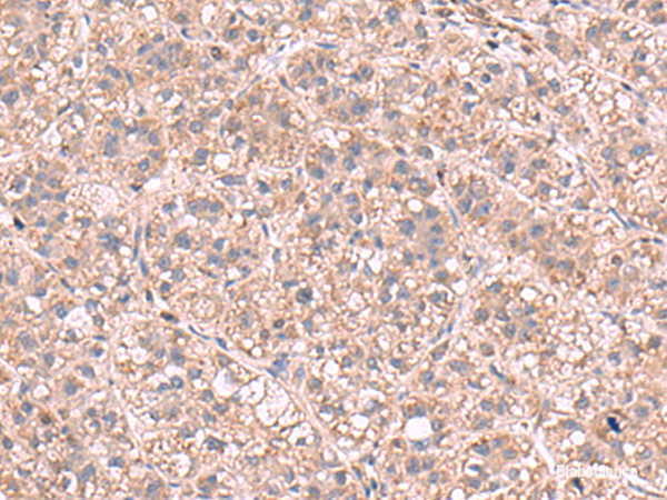 Immunohistochemistry of paraffin-embedded Human liver cancer tissue using KPNA2 Polyclonal Antibody at dilution of 1:60(×200)