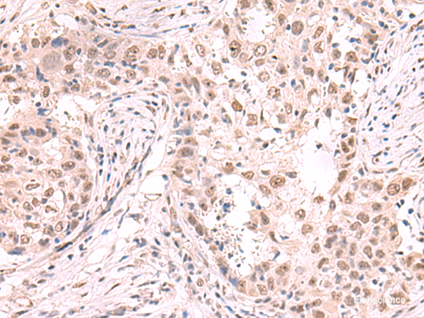 Immunohistochemistry of paraffin-embedded Human esophagus cancer tissue using ZNF559 Polyclonal Antibody at dilution of 1:80(×200)