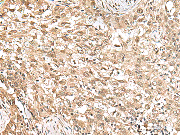Immunohistochemistry of paraffin-embedded Human esophagus cancer tissue using RPS6KA5 Polyclonal Antibody at dilution of 1:160(×200)
