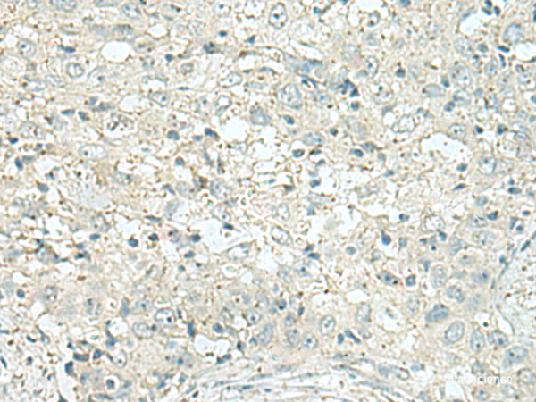 Immunohistochemistry of paraffin-embedded Human esophagus cancer tissue using DENND6A Polyclonal Antibody at dilution of 1:120(×200)