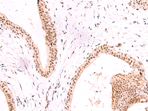 Immunohistochemistry of paraffin-embedded Human breast cancer tissue using CBFA2T2 Polyclonal Antibody at dilution of 1:60(×200)