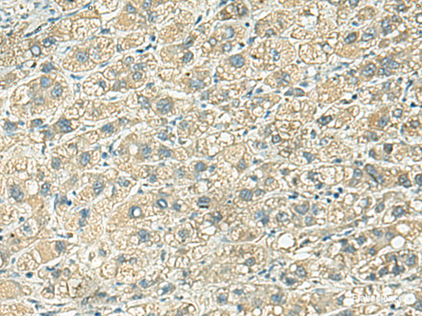 Immunohistochemistry of paraffin-embedded Human liver cancer tissue using KLC2 Polyclonal Antibody at dilution of 1:100(×200)