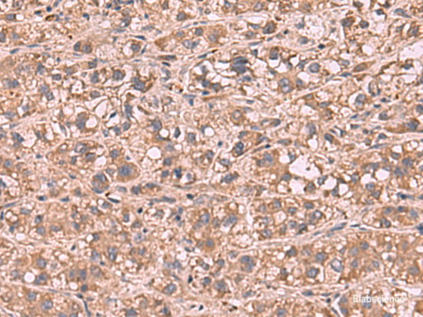 Immunohistochemistry of paraffin-embedded Human liver cancer tissue using SHC4 Polyclonal Antibody at dilution of 1:90(×200)