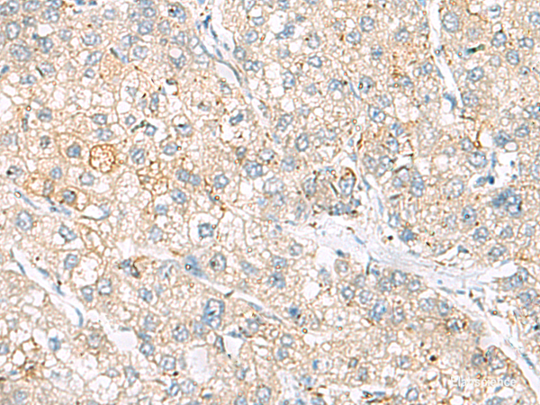 Immunohistochemistry of paraffin-embedded Human liver cancer tissue using FARP2 Polyclonal Antibody at dilution of 1:55(×200)