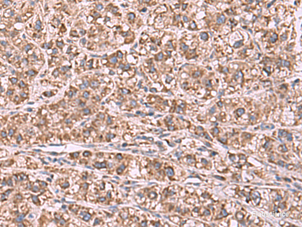 Immunohistochemistry of paraffin-embedded Human liver cancer tissue using GUSB Polyclonal Antibody at dilution of 1:75(×200)