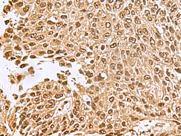 Immunohistochemistry of paraffin-embedded Human lung cancer tissue using NVL Polyclonal Antibody at dilution of 1:70(×200)