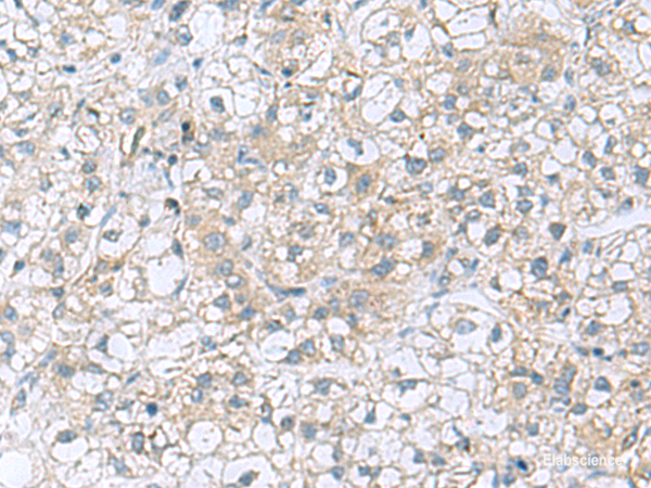 Immunohistochemistry of paraffin-embedded Human liver cancer tissue using TRO Polyclonal Antibody at dilution of 1:80(×200)