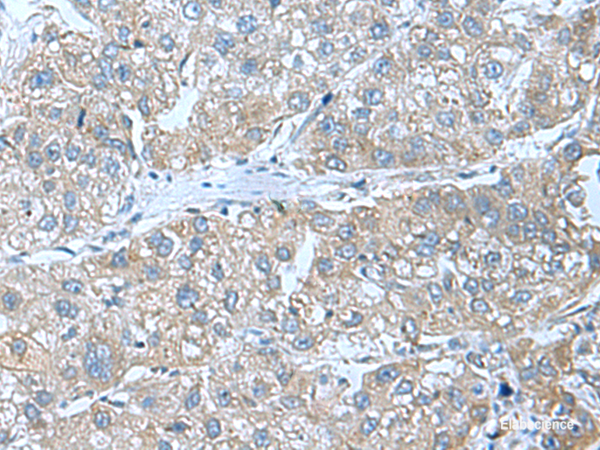 Immunohistochemistry of paraffin-embedded Human liver cancer tissue using SRPK2 Polyclonal Antibody at dilution of 1:55(×200)