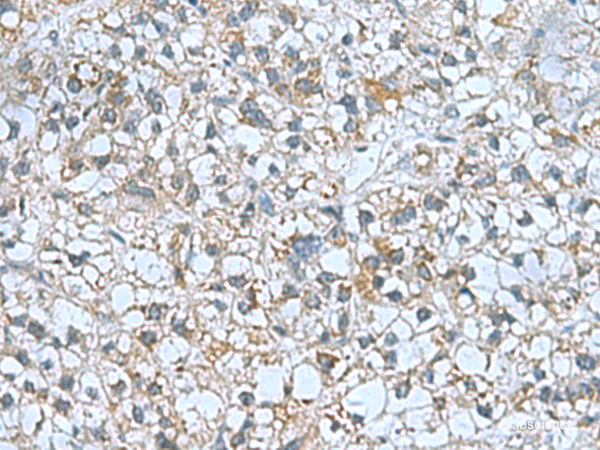 Immunohistochemistry of paraffin-embedded Human liver cancer tissue using CNTN4 Polyclonal Antibody at dilution of 1:60(×200)