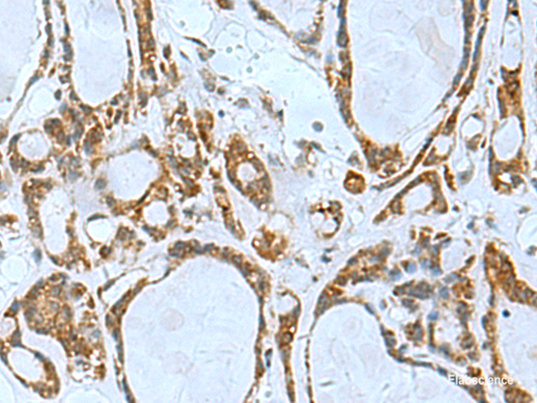 Immunohistochemistry of paraffin-embedded Human thyroid cancer tissue using TSGA10 Polyclonal Antibody at dilution of 1:50(×200)