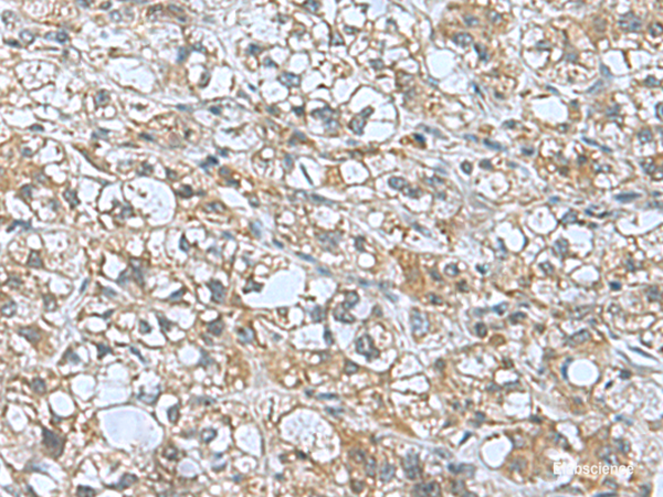 Immunohistochemistry of paraffin-embedded Human liver cancer tissue using KANSL1L Polyclonal Antibody at dilution of 1:55(×200)