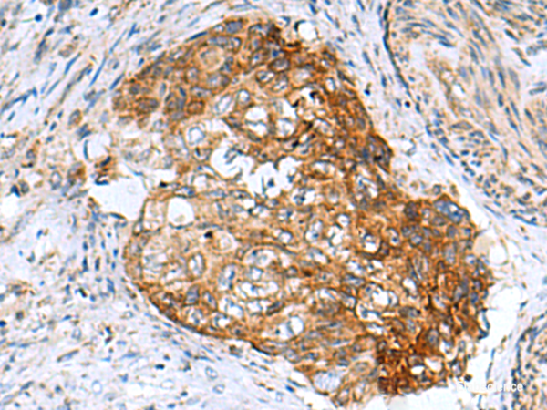 Immunohistochemistry of paraffin-embedded Human cervical cancer tissue using AP1S3 Polyclonal Antibody at dilution of 1:55(×200)