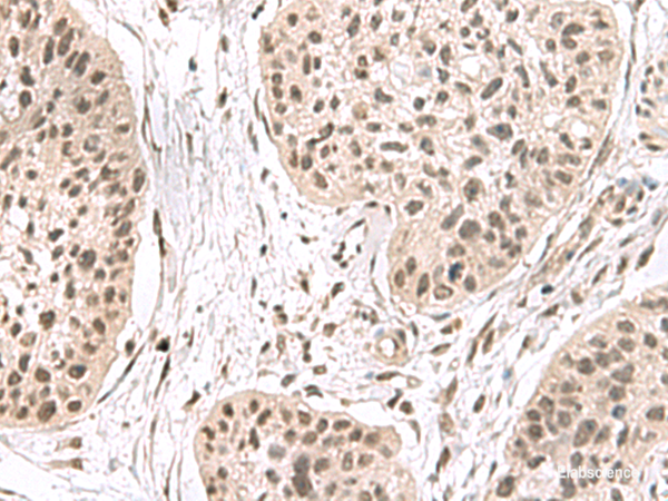 Immunohistochemistry of paraffin-embedded Human esophagus cancer tissue using ERH Polyclonal Antibody at dilution of 1:55(×200)
