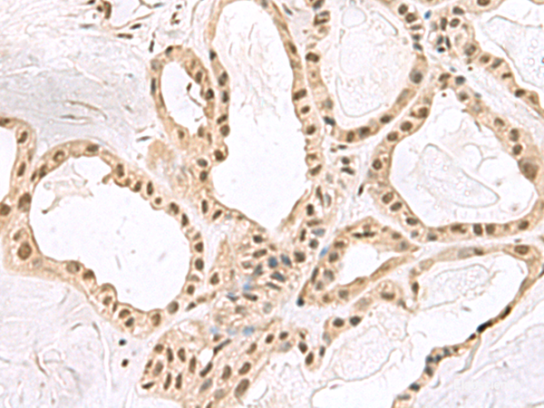 Immunohistochemistry of paraffin-embedded Human thyroid cancer tissue using PCLAF Polyclonal Antibody at dilution of 1:60(×200)