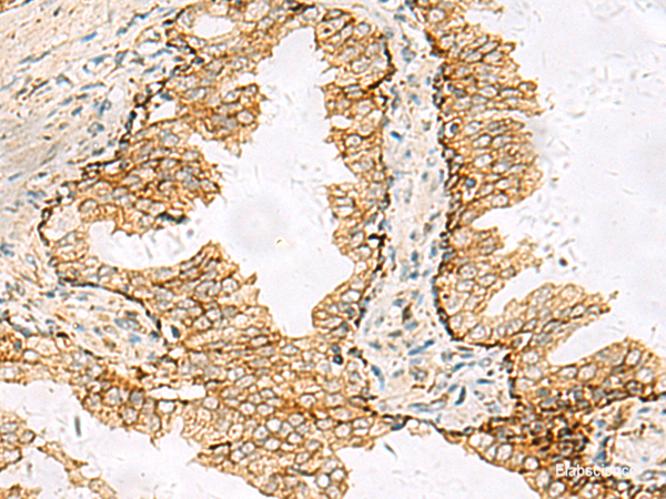 Immunohistochemistry of paraffin-embedded Human prost at e cancer tissue using SH3YL1 Polyclonal Antibody at dilution of 1:55(×200)