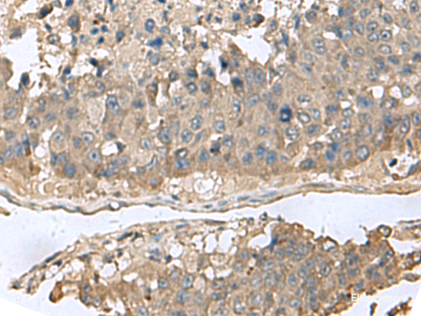 Immunohistochemistry of paraffin-embedded Human liver cancer tissue using GABARAPL2 Polyclonal Antibody at dilution of 1:60(×200)