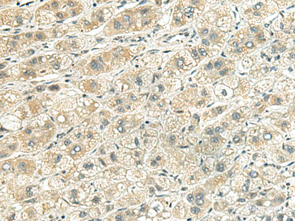 Immunohistochemistry of paraffin-embedded Human liver cancer tissue using RHBDL2 Polyclonal Antibody at dilution of 1:140(×200)