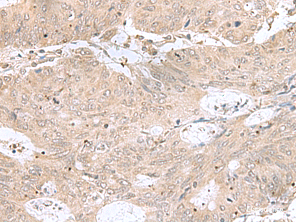 Immunohistochemistry of paraffin-embedded Human colorectal cancer tissue using RPL35 Polyclonal Antibody at dilution of 1:50(×200)