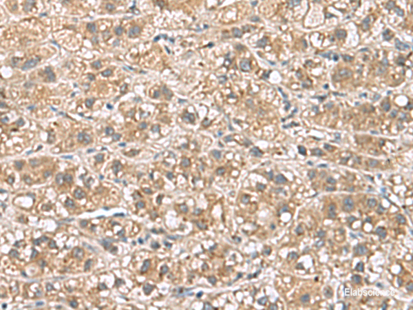 Immunohistochemistry of paraffin-embedded Human liver cancer tissue using PHLDA3 Polyclonal Antibody at dilution of 1:110(×200)