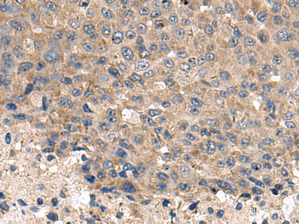 Immunohistochemistry of paraffin-embedded Human liver cancer tissue using CD59 Polyclonal Antibody at dilution of 1:120(×200)