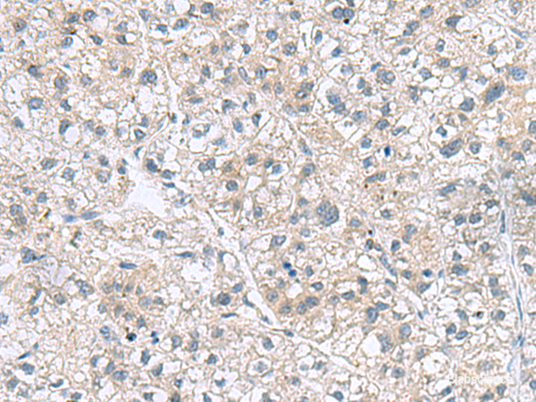 Immunohistochemistry of paraffin-embedded Human liver cancer tissue using GEMIN7 Polyclonal Antibody at dilution of 1:70(×200)