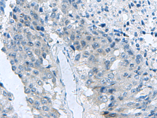 Immunohistochemistry of paraffin-embedded Human liver cancer tissue using MED31 Polyclonal Antibody at dilution of 1:140(×200)