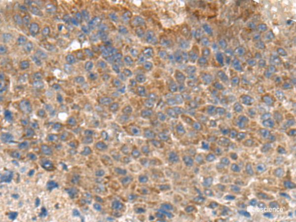 Immunohistochemistry of paraffin-embedded Human liver cancer tissue using MIA Polyclonal Antibody at dilution of 1:180(×200)