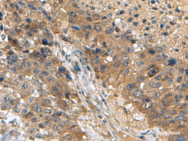 Immunohistochemistry of paraffin-embedded Human liver cancer tissue using TPD52L3 Polyclonal Antibody at dilution of 1:140(×200)