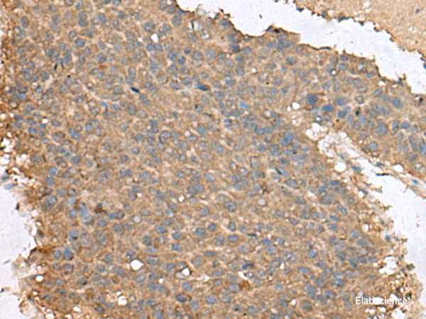 Immunohistochemistry of paraffin-embedded Human liver cancer tissue using FAM19A4 Polyclonal Antibody at dilution of 1:65(×200)