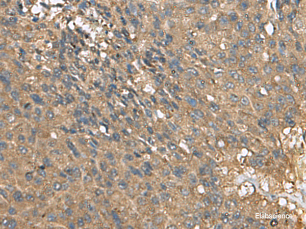 Immunohistochemistry of paraffin-embedded Human liver cancer tissue using EIF1AX Polyclonal Antibody at dilution of 1:105(×200)
