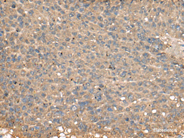 Immunohistochemistry of paraffin-embedded Human liver cancer tissue using PLA2G2A Polyclonal Antibody at dilution of 1:55(×200)
