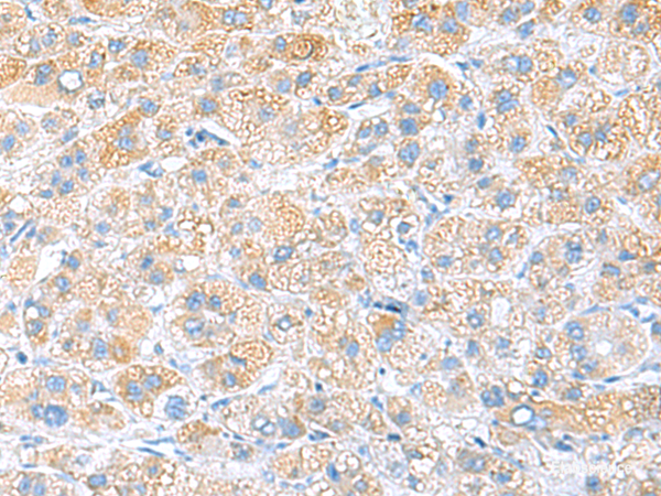 Immunohistochemistry of paraffin-embedded Human liver cancer tissue using RPS16 Polyclonal Antibody at dilution of 1:65(×200)