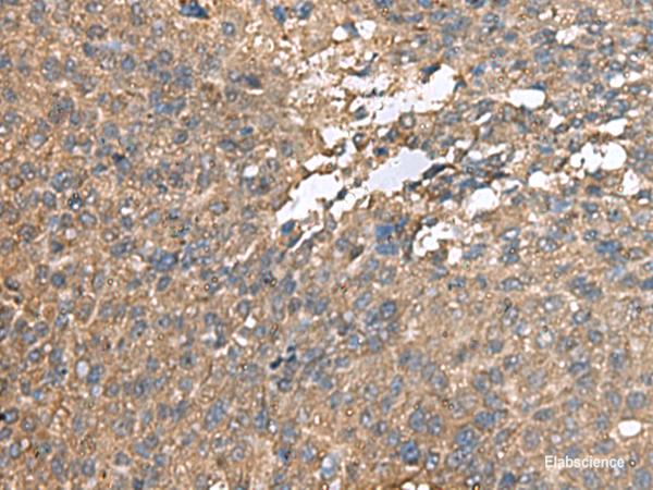 Immunohistochemistry of paraffin-embedded Human liver cancer tissue using AHNAK Polyclonal Antibody at dilution of 1:100(×200)