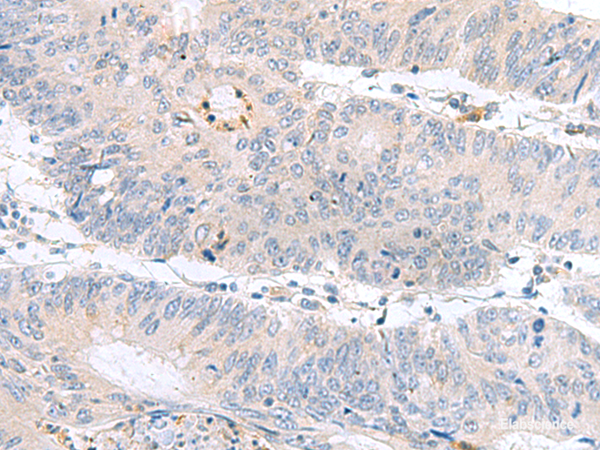Immunohistochemistry of paraffin-embedded Human colorectal cancer tissue using PDE6D Polyclonal Antibody at dilution of 1:60(×200)