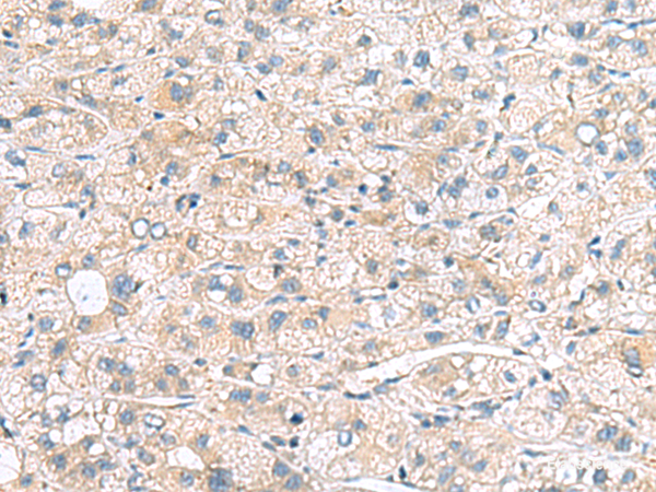 Immunohistochemistry of paraffin-embedded Human liver cancer tissue using MYL1 Polyclonal Antibody at dilution of 1:75(×200)