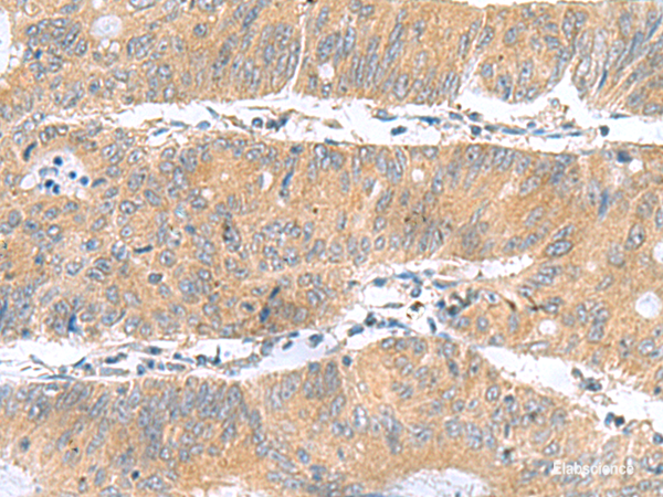 Immunohistochemistry of paraffin-embedded Human colorectal cancer tissue using DNAL1 Polyclonal Antibody at dilution of 1:50(×200)